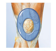 膝の解剖学的な形状に基づき成形されたピスコエラスティックインサート